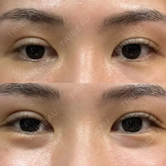 二重埋没 大塚美容形成外科 銀座本院 DAY 5 メイン用