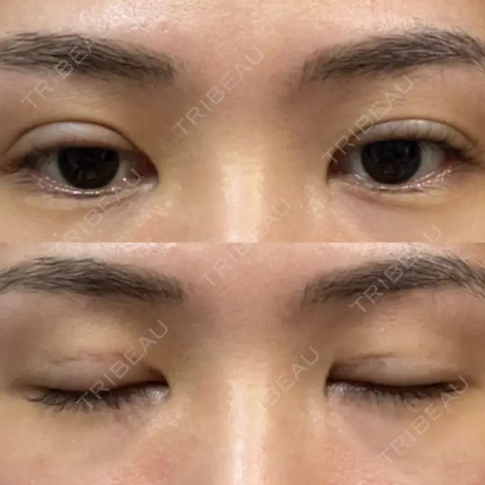 二重埋没 大塚美容形成外科 銀座本院 DAY 6 メイン用