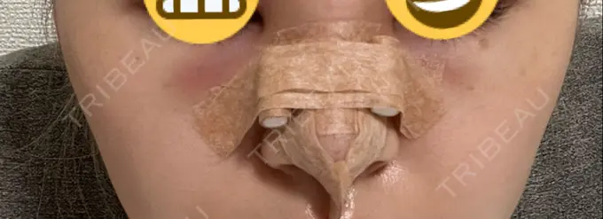 隆鼻術 聖心美容クリニック 福岡院 DAY 1 メイン用