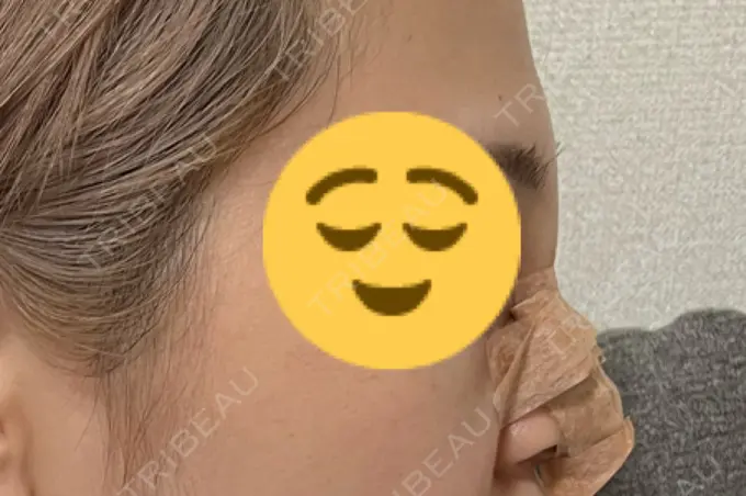 隆鼻術 聖心美容クリニック 福岡院 DAY 1 メイン用