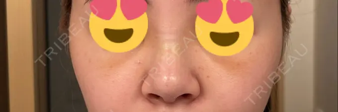 隆鼻術 聖心美容クリニック 福岡院 DAY 3 メイン用