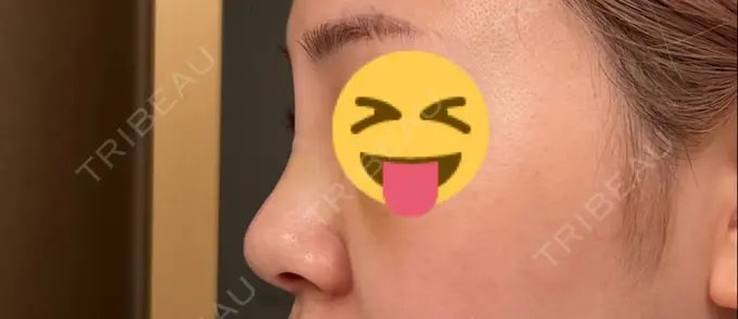 隆鼻術 聖心美容クリニック 福岡院 DAY 3 メイン用