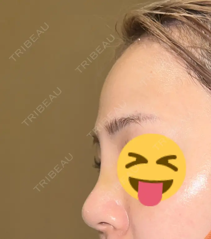 隆鼻術 聖心美容クリニック 福岡院 DAY 4 メイン用