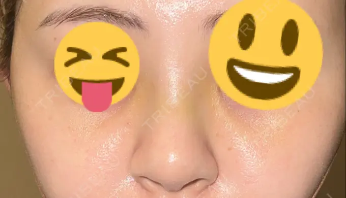 隆鼻術 聖心美容クリニック 福岡院 DAY 4 メイン用