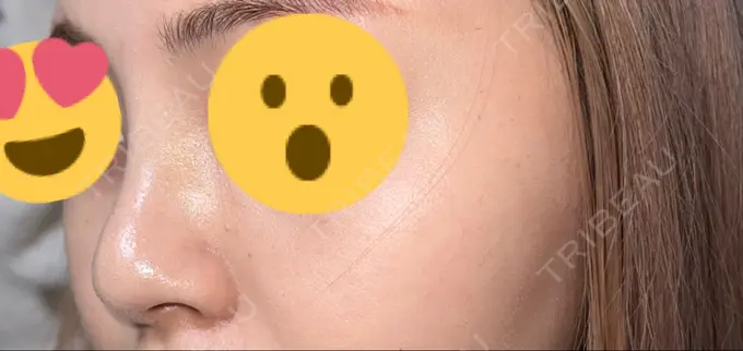 隆鼻術 聖心美容クリニック 福岡院 AFTER メイン用