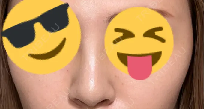 隆鼻術 聖心美容クリニック 福岡院 DAY 10 メイン用