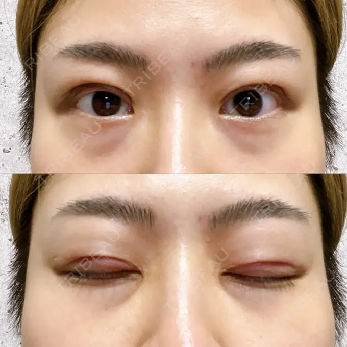 二重切開 みずほクリニック DAY 14 メイン用