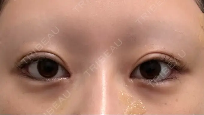 目頭切開 / クマ治療 / 目尻切開 / 下まぶたの脂肪取り / タレ目形成・グラマラスライン（切開） POP美容整形クリニック DAY 10 メイン用