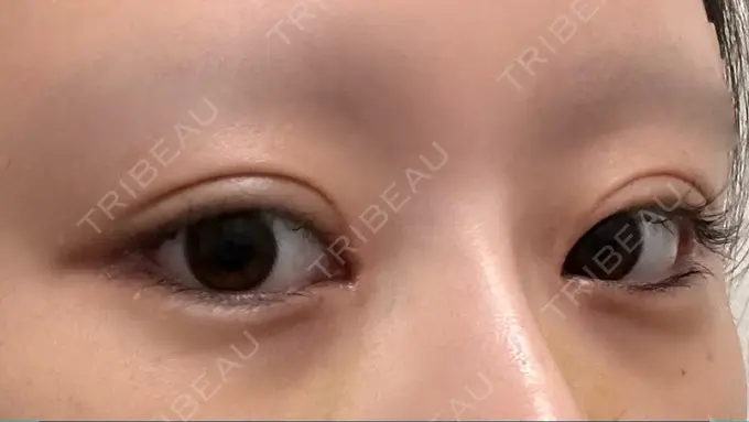 目頭切開 / クマ治療 / 目尻切開 / 下まぶたの脂肪取り / タレ目形成・グラマラスライン（切開） POP美容整形クリニック DAY 10 メイン用