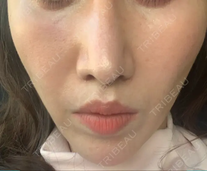 その他（輪郭） 栄美容クリニック 栄院 DAY 6 メイン用