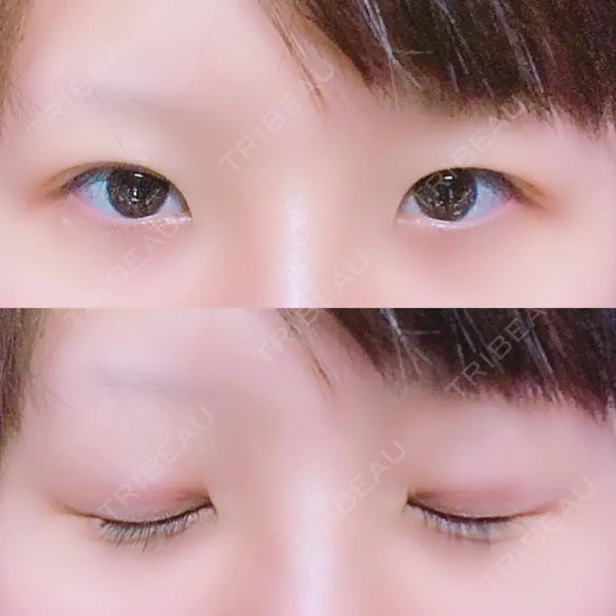 眼瞼下垂（切開） みずほクリニック DAY 69 メイン用