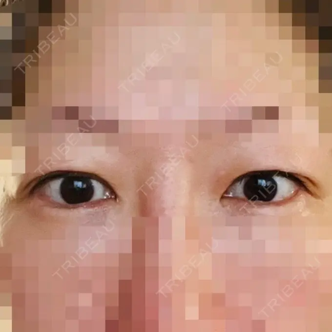 目尻切開 / タレ目形成・グラマラスライン（埋没） LOUIS CLINIC 二子玉川院【ルイクリニック】 DAY 32 メイン用