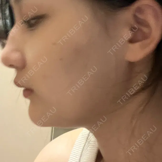 脂肪溶解注射（顔） 表参道ウィズ・クリニック AFTER メイン用