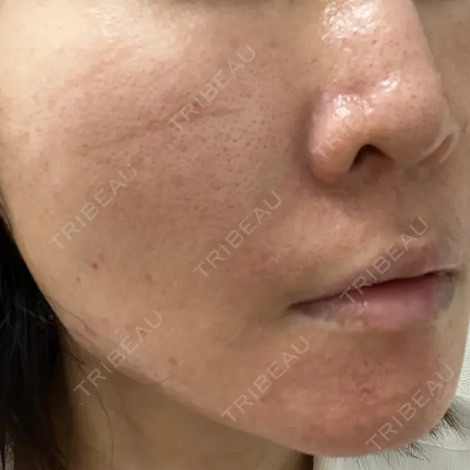 ヒアルロン酸注入（鼻） / 肌ヒアルロン酸注入（たるみ・シワ改善） HAAB BEAUTY CLINIC 名古屋院 DAY 6 メイン用