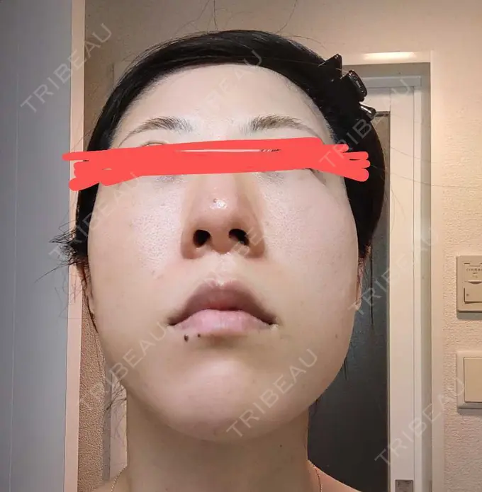 鼻尖形成（切開） / 軟骨移植 / 鼻柱下降・鼻唇角形成（猫手術） グローバルビューティークリニック 大阪院 DAY 354 メイン用