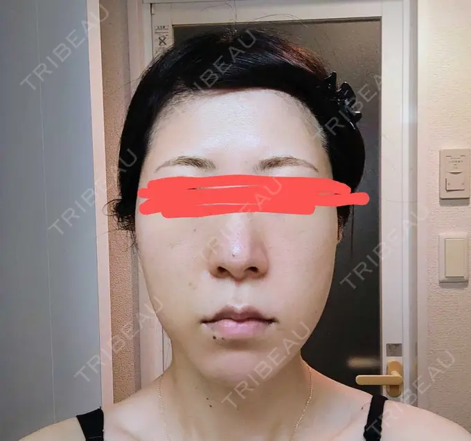 鼻尖形成（切開） / 軟骨移植 / 鼻柱下降・鼻唇角形成（猫手術） グローバルビューティークリニック 大阪院 AFTER メイン用