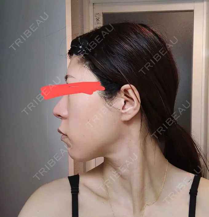 鼻尖形成（切開） / 軟骨移植 / 鼻柱下降・鼻唇角形成（猫手術） グローバルビューティークリニック 大阪院 DAY 354 メイン用