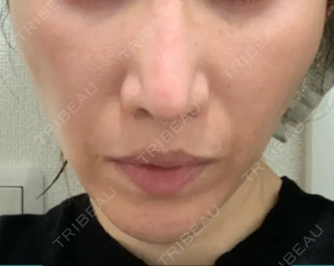 その他（輪郭） 栄美容クリニック 栄院 DAY 8 メイン用