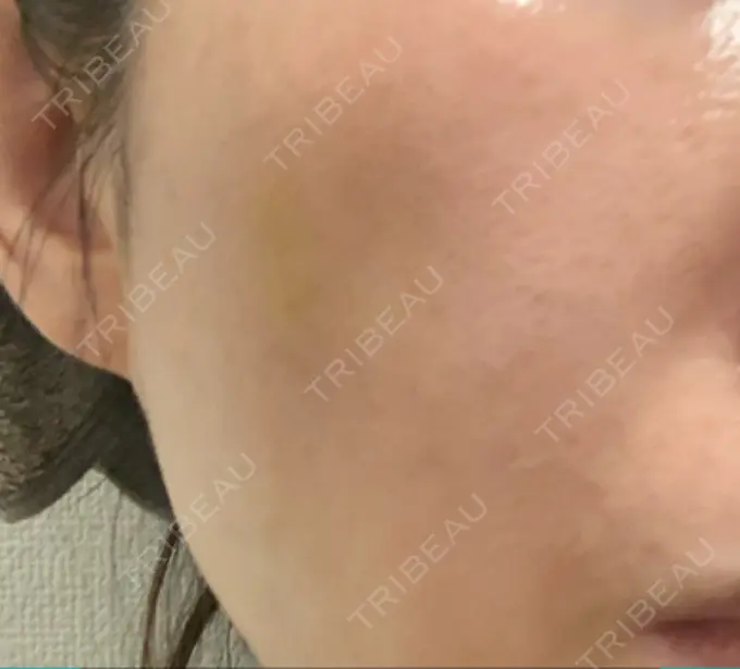 その他（輪郭） 栄美容クリニック 栄院 DAY 8 メイン用