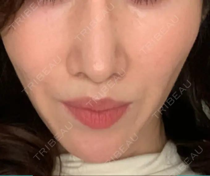 その他（輪郭） 栄美容クリニック 栄院 DAY 9 メイン用