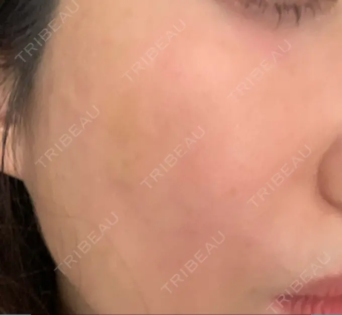 その他（輪郭） 栄美容クリニック 栄院 DAY 9 メイン用