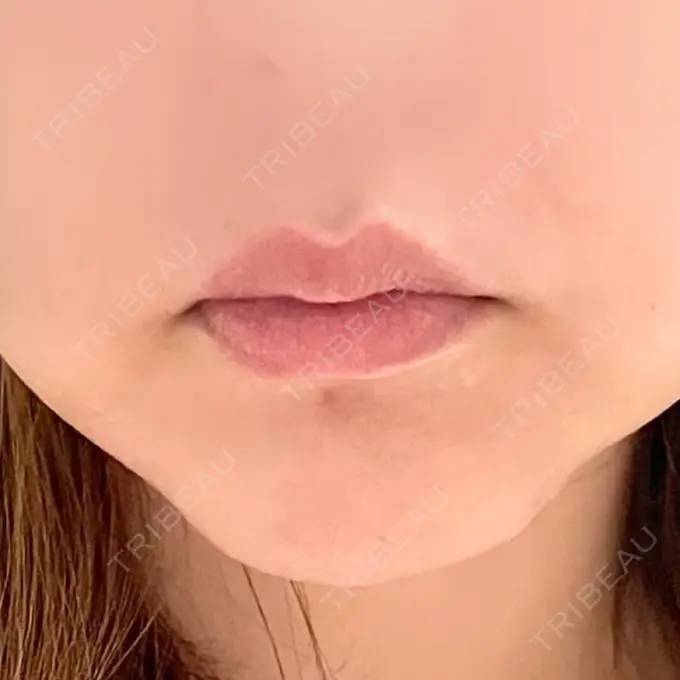 口角挙上 宇都宮竹内クリニック DAY 735 メイン用