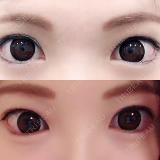 ヒアルロン酸注入（涙袋） しのぶ皮膚科 DAY 21 メイン用