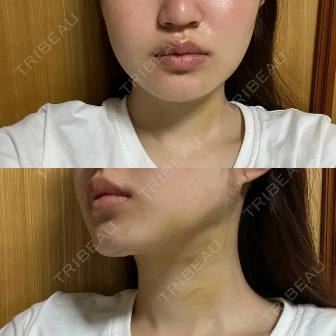 糸リフト / 脂肪吸引（顔） Casa de GRACIA GINZA 【カーサデグラシアギンザ】 DAY 3 メイン用