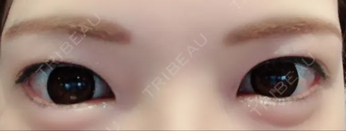 ヒアルロン酸注入（涙袋） しのぶ皮膚科 DAY 24 メイン用