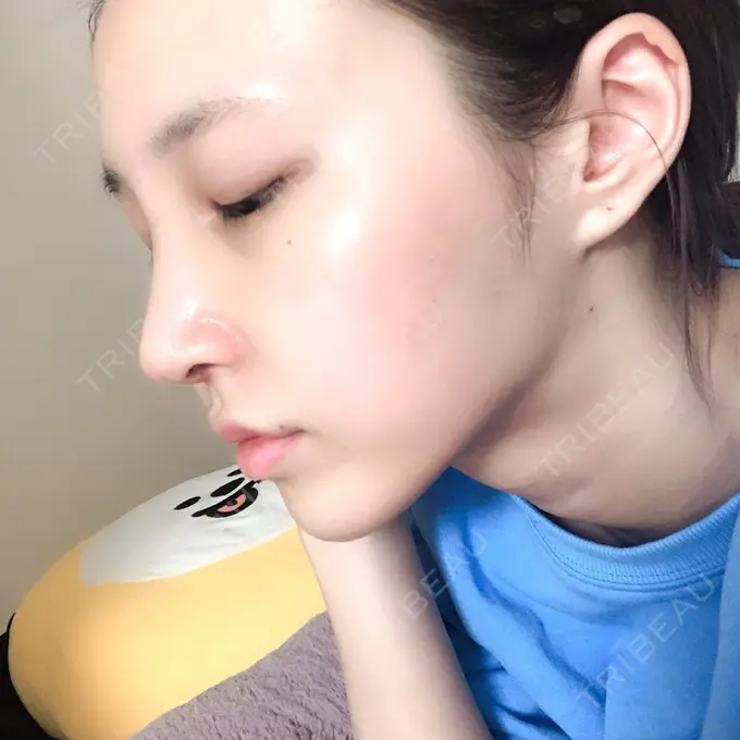 隆鼻術 / 鼻尖形成（切開） / 鼻中隔延長（切開） / 軟骨移植 / その他（鼻） FROM B整形外科 (旧バウム整形外科) DAY 10 メイン用