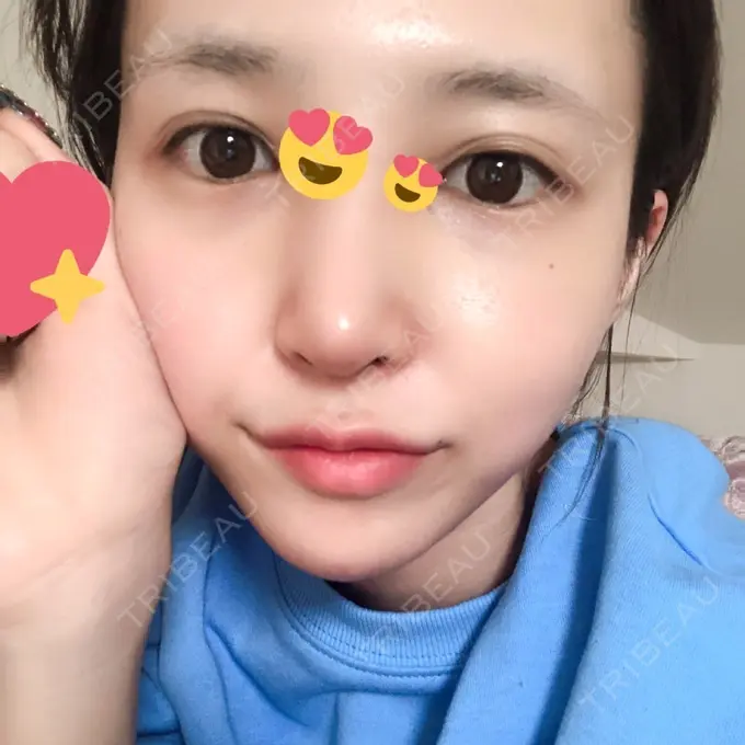 隆鼻術 / 鼻尖形成（切開） / 鼻中隔延長（切開） / 軟骨移植 / その他（鼻） FROM B整形外科 (旧バウム整形外科) DAY 10 メイン用