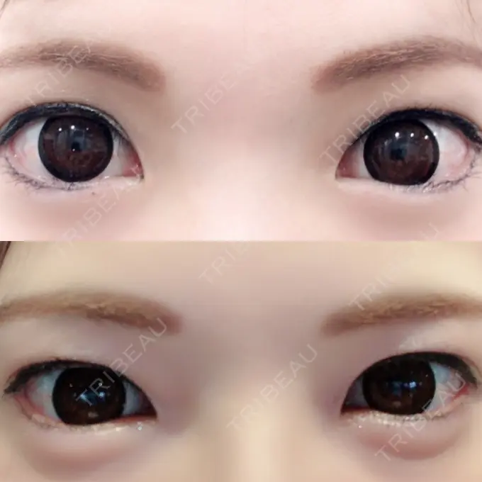 ヒアルロン酸注入（涙袋） しのぶ皮膚科 DAY 24 メイン用