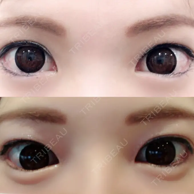 ヒアルロン酸注入（涙袋） しのぶ皮膚科 DAY 26 メイン用