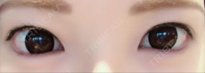 ヒアルロン酸注入（涙袋） しのぶ皮膚科 AFTER メイン用