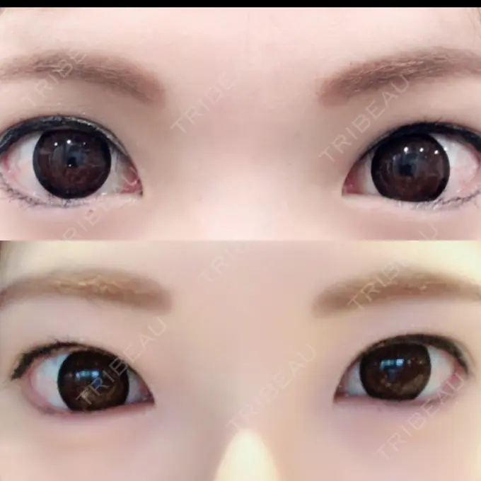 ヒアルロン酸注入（涙袋） しのぶ皮膚科 DAY 27 メイン用