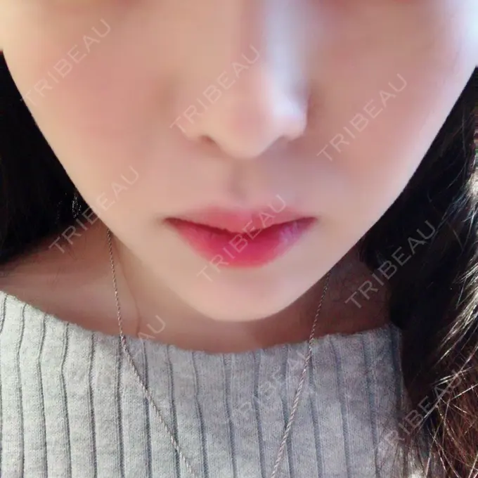 脂肪溶解注射（顔） S Beauty Clinic DAY 50 メイン用