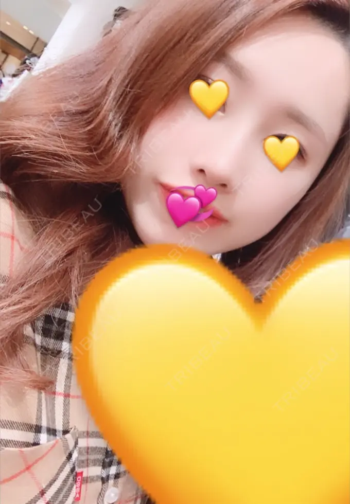 小鼻縮小（切開） / その他（鼻） FROM B整形外科 (旧バウム整形外科) DAY 14 メイン用