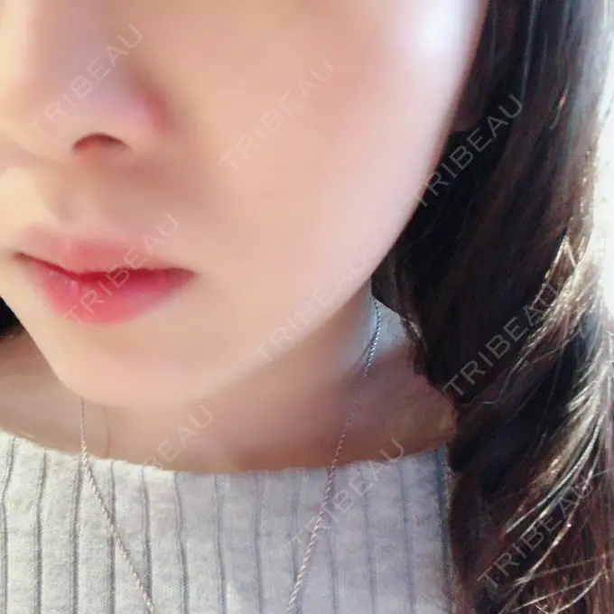 脂肪溶解注射（顔） S Beauty Clinic DAY 50 メイン用