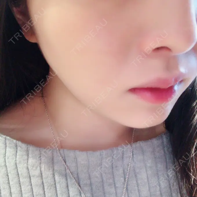 脂肪溶解注射（顔） S Beauty Clinic DAY 50 メイン用