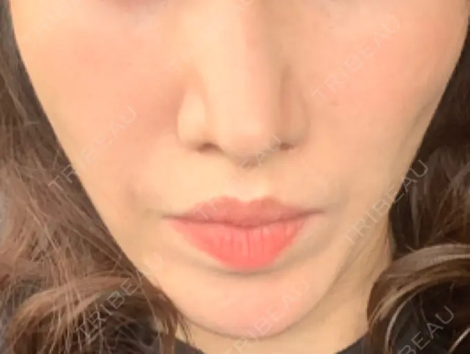 その他（輪郭） 栄美容クリニック 栄院 DAY 13 メイン用