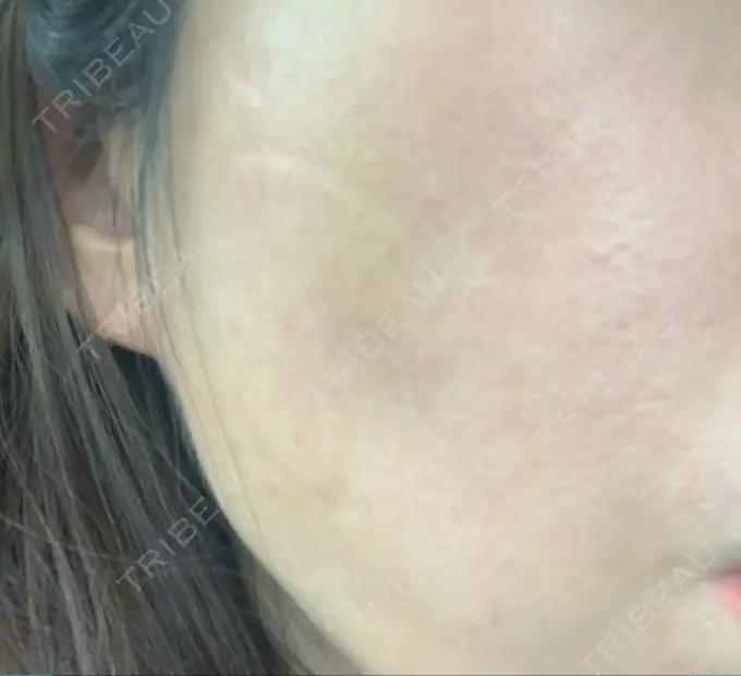 その他（輪郭） 栄美容クリニック 栄院 DAY 13 メイン用