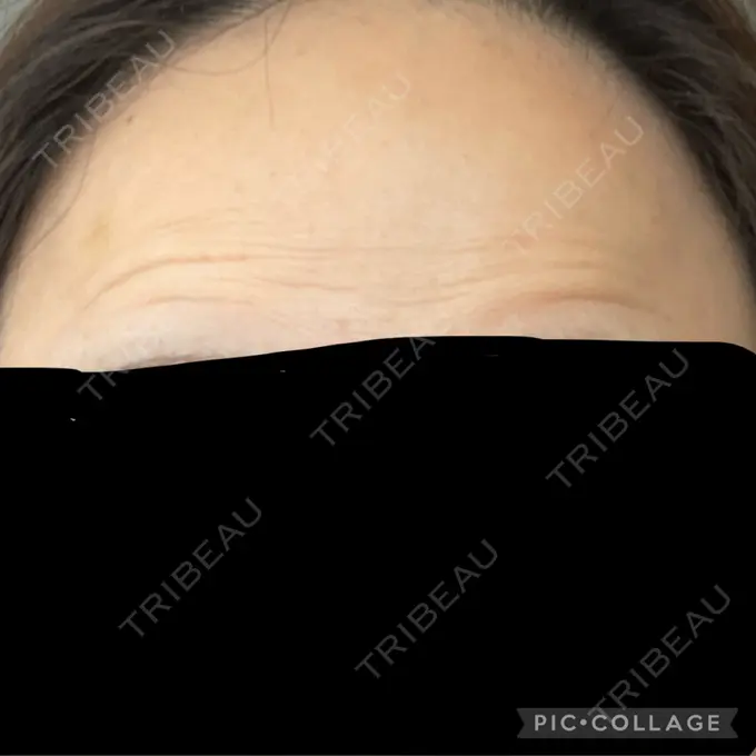 ボトックス（額） TCB東京中央美容外科 神戸院 AFTER メイン用