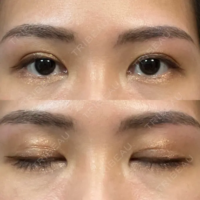 二重埋没 大塚美容形成外科 銀座本院 AFTER メイン用