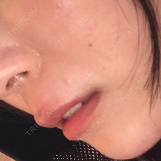 ヒアルロン酸注入（唇） LIKI CLINIC KOBE DAY 12 メイン用