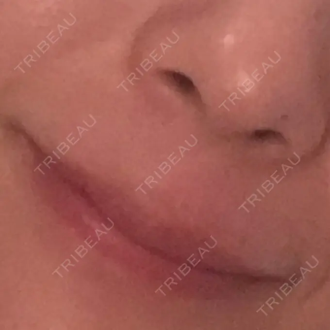 ヒアルロン酸注入（唇） LIKI CLINIC KOBE AFTER メイン用