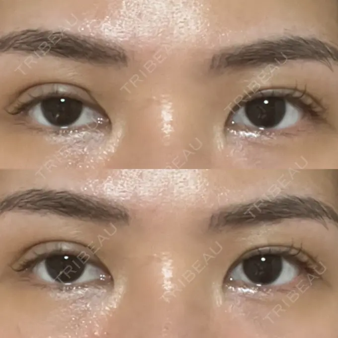 二重埋没 大塚美容形成外科 銀座本院 DAY 1 メイン用