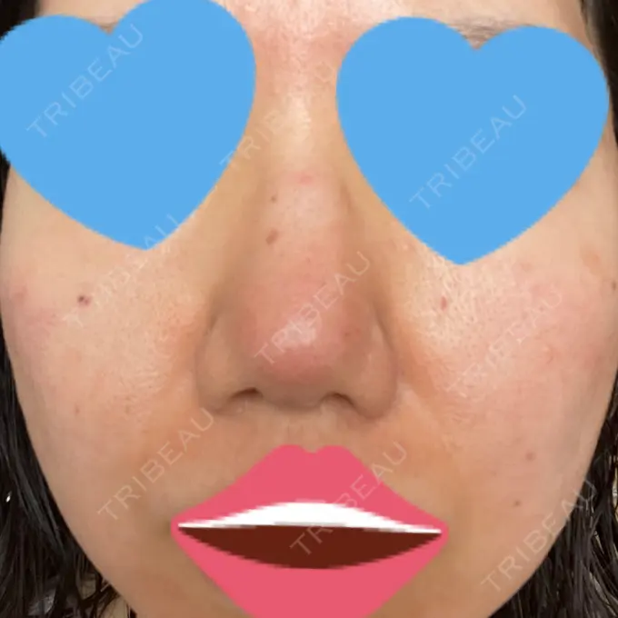 毛穴洗浄（ハイドラフェイシャルなど） / ヴェルヴェットスキン ミニマムスキンクリニック池袋 DAY 1 メイン用