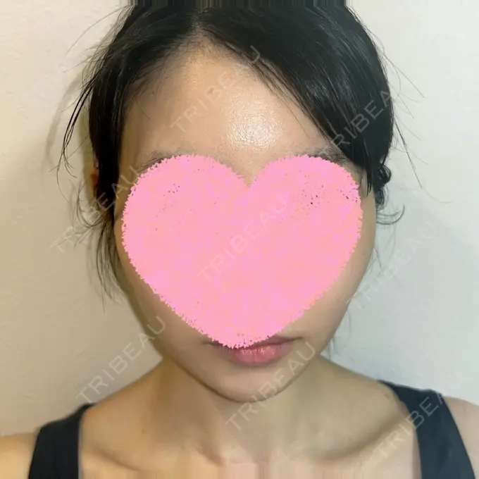 糸リフト / クマ治療 / 下まぶたの脂肪取り / ボトックス（額） Mods Clinic（モッズクリニック） 名古屋院 DAY 92 メイン用