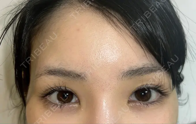 糸リフト / クマ治療 / 下まぶたの脂肪取り / ボトックス（額） Mods Clinic（モッズクリニック） 名古屋院 DAY 92 メイン用