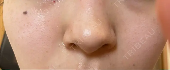 毛穴洗浄（ハイドラフェイシャルなど） KM新宿クリニック AFTER メイン用